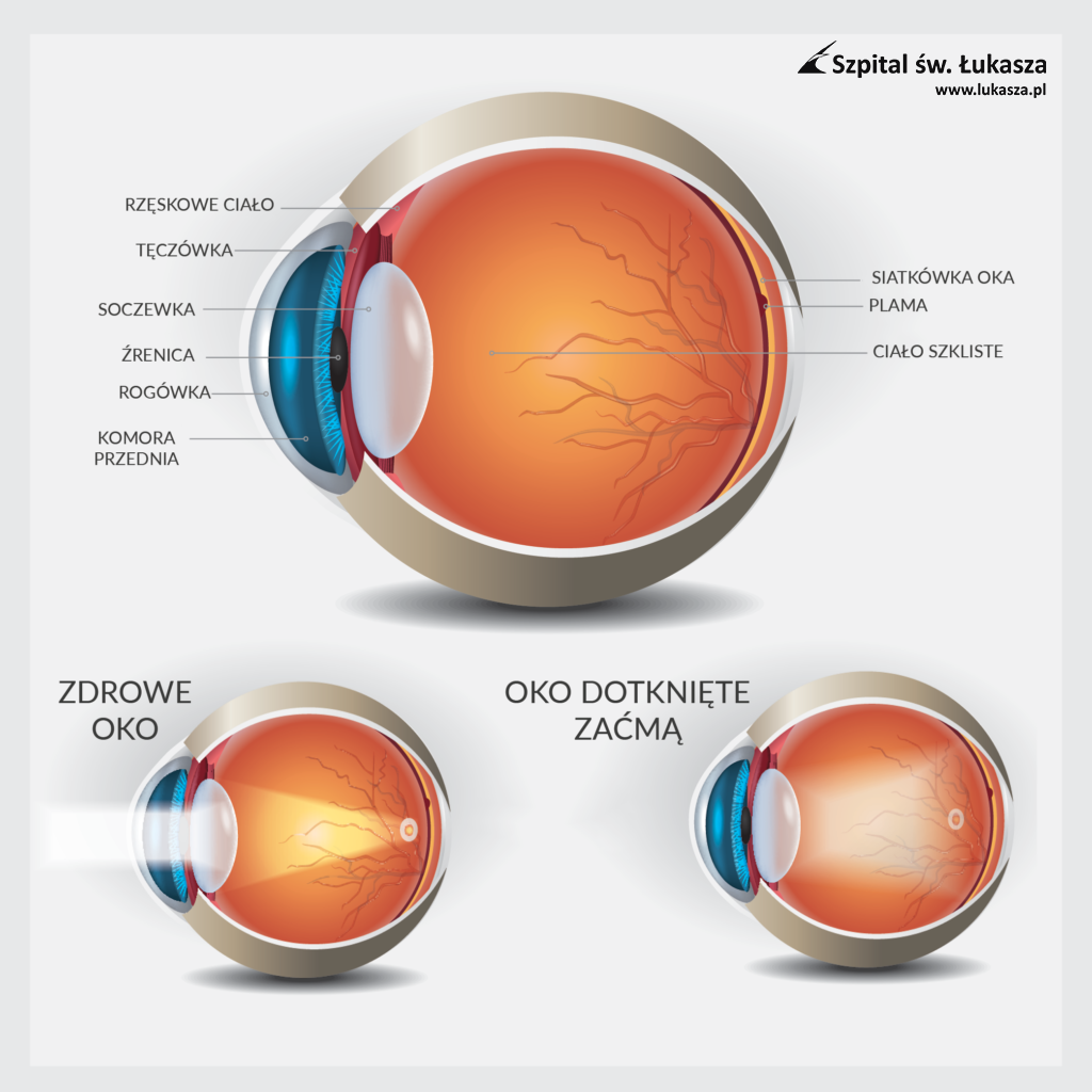 przykład oka z zaćmą